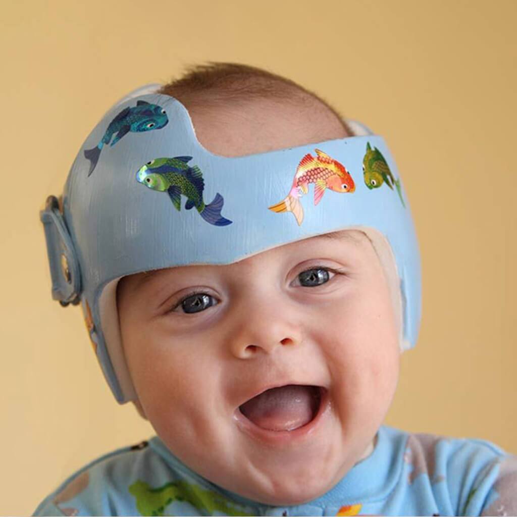 Infant receiving pediatric cranial remolding care